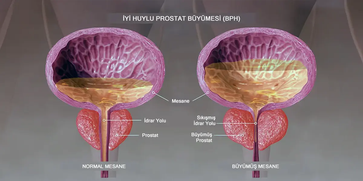 İyi Huylu Prostat Büyümesi